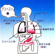 アスベスト繊維による人体への影響